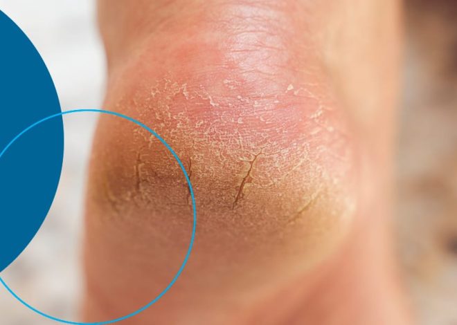 How to naturally reduce cracks on the feet, hands?