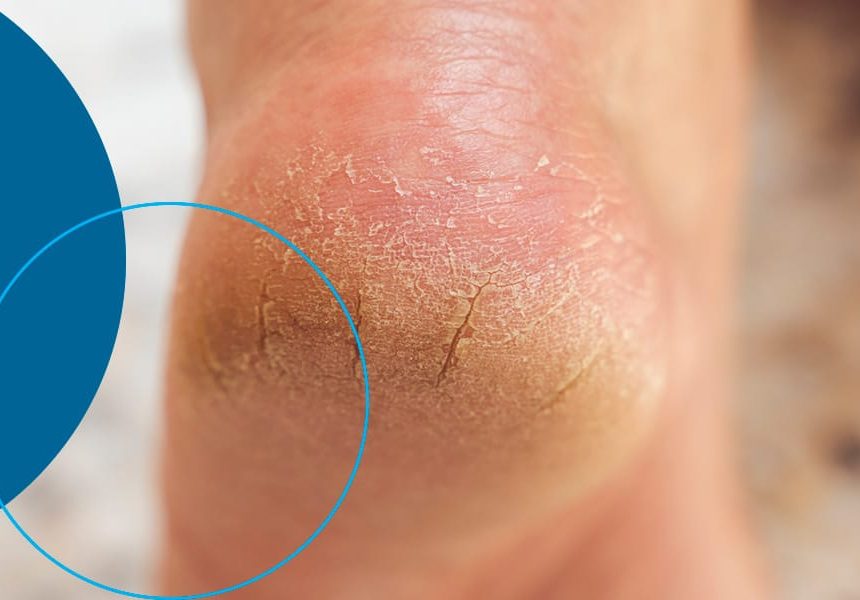 How to naturally reduce cracks on the feet, hands?