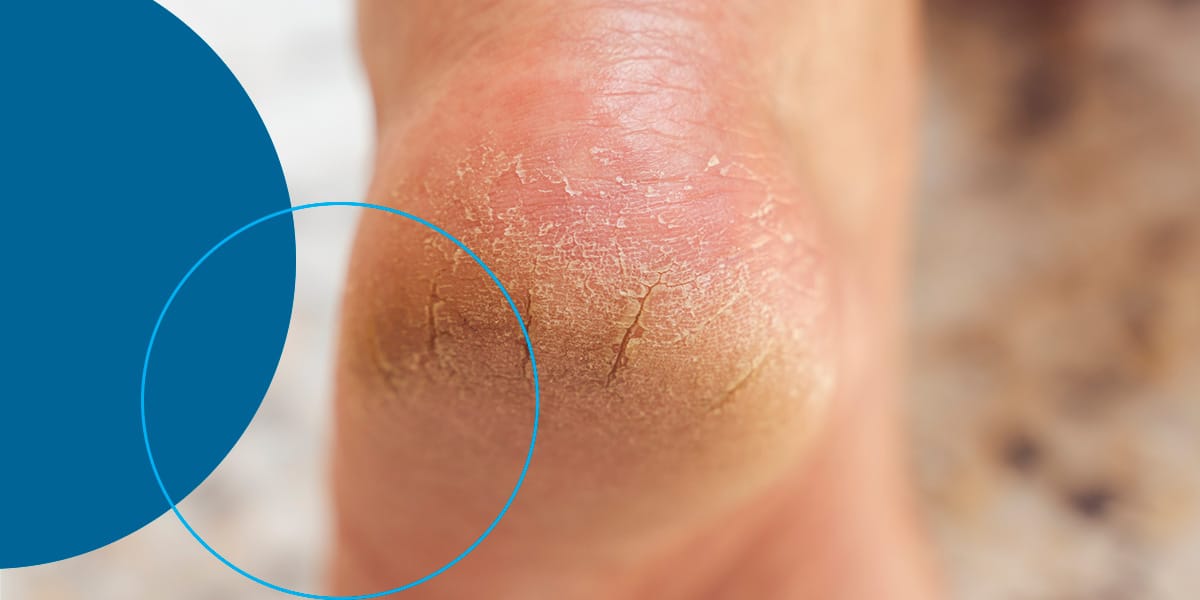 How to naturally reduce cracks on the feet, hands?